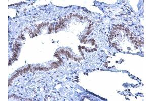 IHC-P Image Rad54 antibody [C3], C-term detects Rad54 protein at nucleus on human lung carcinoma by immunohistochemical analysis. (ATRX anticorps  (C-Term))