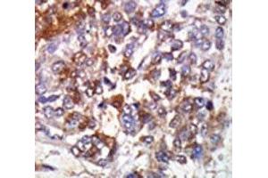 IHC analysis of FFPE human hepatocarcinoma stained with the cGKI beta antibody (PRKG1 anticorps  (AA 629-660))