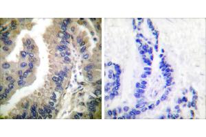 Peptide - +Immunohistochemical analysis of paraffin-embedded human lung carcinoma tissue using HSP90 cyto antibody (#C0234).
