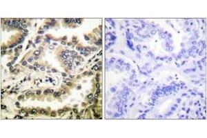 Immunohistochemistry analysis of paraffin-embedded human lung carcinoma tissue, using NF-kappaB p65 (Acetyl-Lys310) Antibody. (NF-kB p65 anticorps  (acLys310))