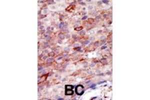 Formalin-fixed and paraffin-embedded human cancer tissue reacted with the primary antibody, which was peroxidase-conjugated to the secondary antibody, followed by DAB staining.