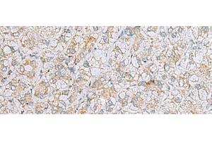 Immunohistochemistry of paraffin-embedded Human liver cancer tissue using LRRC49 Polyclonal Antibody at dilution of 1:40(x200) (LRRC49 anticorps)