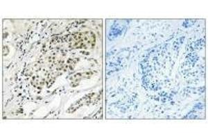 Immunohistochemistry analysis of paraffin-embedded human breast carcinoma tissue using CDYL2 antibody. (CDYL2 anticorps  (N-Term))