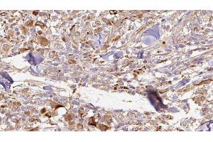 ABIN6277073 at 1/100 staining Human Melanoma tissue by IHC-P.