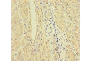 Immunohistochemistry of paraffin-embedded human liver cancer using ABIN7167064 at dilution of 1:100 (RFTN2 anticorps  (AA 1-300))