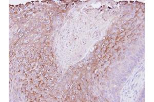 IHC-P Image Immunohistochemical analysis of paraffin-embedded Cal27 xenograft , using PIGR, antibody at 1:500 dilution.