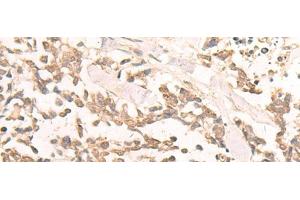 Immunohistochemistry of paraffin-embedded Human lung cancer tissue using EN2 Polyclonal Antibody at dilution of 1:30(x200) (EN2 anticorps)