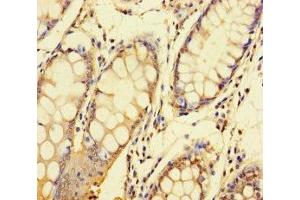 Immunohistochemistry of paraffin-embedded human colon cancer using ABIN7148417 at dilution of 1:100 (NDUFAF1 anticorps  (AA 25-327))