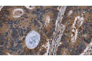 Immunohistochemistry of paraffin-embedded Human colon cancer tissue using TSC22D3 Polyclonal Antibody at dilution 1:40