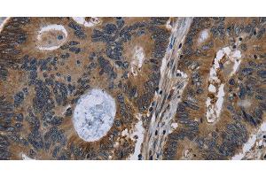 Immunohistochemistry of paraffin-embedded Human colon cancer tissue using TSC22D3 Polyclonal Antibody at dilution 1:40 (TSC22D3 anticorps)