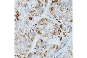 Immunohistochemistry of paraffin-embedded human liver cancer using Alkaline Phosphatase (ALPL) Rabbit pAb (ABIN3021385, ABIN3021386, ABIN1512569 and ABIN6214987) at dilution of 1:50 (40x lens).