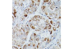 Immunohistochemistry of paraffin-embedded human liver cancer using Alkaline Phosphatase (ALPL) Rabbit pAb (ABIN3021385, ABIN3021386, ABIN1512569 and ABIN6214987) at dilution of 1:50 (40x lens). (ALPL anticorps  (AA 20-270))