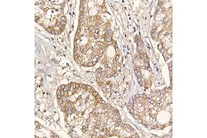 Immunohistochemistry of paraffin-embedded human lung cancer using ERp19 Rabbit mAb (ABIN7270799) at dilution of 1:200 (40x lens). (TXNDC12 anticorps)
