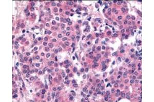Affinity Purified Plk1 pT210 was used at a 1:200 dilution to detect Plk1 by immunohistochemistry in human breast carcinoma tumor tissue.
