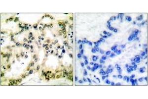 Immunohistochemistry analysis of paraffin-embedded human lung carcinoma, using Cyclin B1 (Phospho-Ser126) Antibody. (Cyclin B1 anticorps  (pSer126))