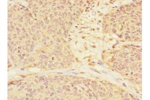 Immunohistochemistry of paraffin-embedded human ovarian cancer using ABIN7167139 at dilution of 1:100 (RASSF6 anticorps  (AA 1-303))