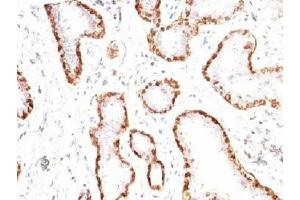 Formalin-fixed, paraffin-embedded human breast carcinoma stained with anti-Calponin antibody (CNN1/832). (Calponin anticorps)