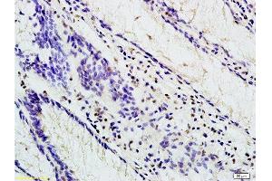 Formalin-fixed and paraffin embedded human colon carcinoma labeled with Anti-TBL1X Polyclonal Antibody, Unconjugated at 1:200 followed by conjugation to the secondary antibody and DAB staining (TBL1Y anticorps  (AA 501-577))