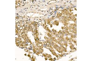 Immunohistochemistry of paraffin-embedded human liver cancer using [KO Validated] RA Rabbit pAb (ABIN3021646, ABIN3021647, ABIN3021648 and ABIN1513457) at dilution of 1:100 (40x lens). (RAB5 anticorps  (AA 1-215))