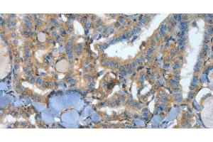 Immunohistochemistry of paraffin-embedded Human thyroid cancer tissue using ATP4B Polyclonal Antibody at dilution 1:40 (ATP4b anticorps)