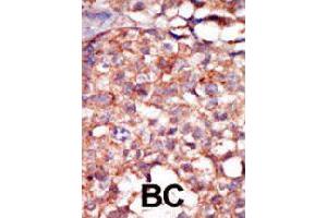 Formalin-fixed and paraffin-embedded human cancer tissue reacted with RIPK4 polyclonal antibody  , which was peroxidase-conjugated to the secondary antibody, followed by AEC staining.