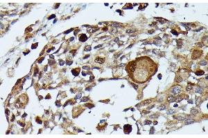 Immunohistochemistry of paraffin-embedded Human esophageal cancer using MAP3K3 Polyclonal Antibody at dilution of 1:100 (40x lens). (MAP3K3 anticorps)