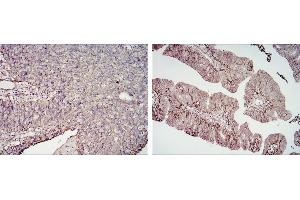 Immunohistochemical analysis of paraffin-embedded cervical cancer tissues (left) and ovarian cancer tissues (right) using CD276 mouse mAb with DAB staining. (CD276 anticorps)