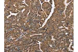 The image on the left is immunohistochemistry of paraffin-embedded Human cervical cancer tissue using ABIN7192064(PTPN20A/PTPN20B Antibody) at dilution 1/40, on the right is treated with synthetic peptide.