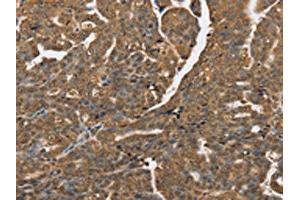 The image on the left is immunohistochemistry of paraffin-embedded Human cervical cancer tissue using ABIN7192064(PTPN20A/PTPN20B Antibody) at dilution 1/40, on the right is treated with synthetic peptide. (PTPN2 anticorps)