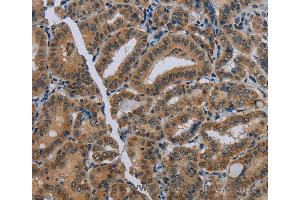 Immunohistochemistry of Human thyroid cancer using NAT10 Polyclonal Antibody at dilution of 1:40 (NAT10 anticorps)