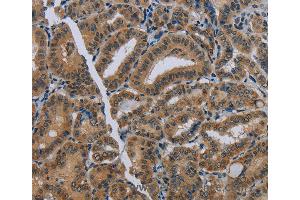 Immunohistochemistry of Human thyroid cancer using NAT10 Polyclonal Antibody at dilution of 1:40 (NAT10 anticorps)