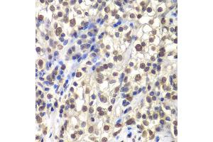 Immunohistochemistry of paraffin-embedded human kidney cancer using CENPC antibody at dilution of 1:200 (400x lens). (CENPC1 anticorps)