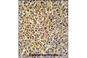 CRIP1 Antibody IHC analysis in formalin fixed and paraffin embedded bladder carcinoma followed by peroxidase conjugation of the secondary antibody and DAB staining. (CRIP1 anticorps  (C-Term))