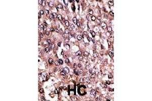 Formalin-fixed and paraffin-embedded human hepatocellular carcinoma tissue reacted with MAGEC1 polyclonal antibody  , which was peroxidase-conjugated to the secondary antibody, followed by AEC staining. (MAGEC1 anticorps  (C-Term))
