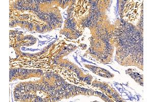 ABIN7093127 and ABIN7098695 at 1/100 staining Human colorectal cancer by IHC-P. (Clca3 anticorps)