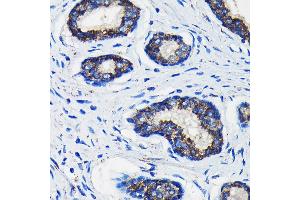 Immunohistochemistry of paraffin-embedded human prostate cancer using AMACR Rabbit pAb (ABIN3021497, ABIN3021498, ABIN3021499 and ABIN6215153) at dilution of 1:100 (40x lens).