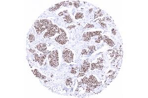 Breast Breast cancer of no special type NST showing moderate to strong GATA3 immunostaining