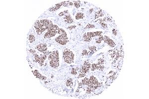 Breast Breast cancer of no special type NST showing moderate to strong GATA3 immunostaining (GATA3 anticorps)
