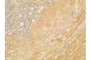 ABIN6260540 and ABIN6276944 at 1/100 staining human tongue carcinoma by IHC-P. (CCL21 anticorps  (C-Term))