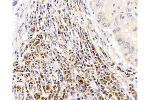 Immunohistochemistry analysis of paraffin-embedded human lung cancer using CASP1 Polyclonal Antibody at dilution of 1:300.
