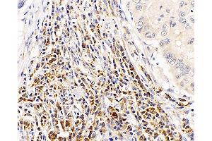 Immunohistochemistry analysis of paraffin-embedded human lung cancer using CASP1 Polyclonal Antibody at dilution of 1:300. (Caspase 1 anticorps)