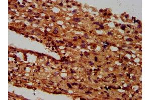 IHC image of ABIN7145527 diluted at 1:600 and staining in paraffin-embedded human melanoma performed on a Leica BondTM system. (SGCB anticorps  (AA 124-219))