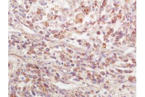 Formalin-fixed and paraffin embedded human lung carcinoma labeled with Rabbit Anti-EPS15R Polyclonal Antibody, Unconjugated  at 1:200 followed by conjugation to the secondary antibody and DAB staining (EPS15L1 anticorps  (AA 275-380))