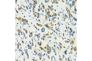 Immunohistochemistry of paraffin-embedded human gastric cancer using SLC25 antibody (ABIN6132660, ABIN6147903, ABIN6147904 and ABIN6224187) at dilution of 1:100 (40x lens).