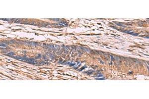 Immunohistochemistry of paraffin-embedded Human colorectal cancer tissue using KCNN2 Polyclonal Antibody at dilution of 1:65(x200) (KCNN2 anticorps)