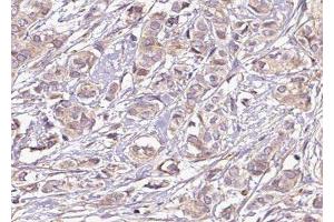 ABIN6275240 at 1/100 staining Human breast cancer tissue by IHC-P. (SLC25A21 anticorps  (Internal Region))