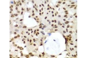 Immunohistochemistry of paraffin-embedded Human oophoroma using LIG3 Polyclonal Antibody at dilution of 1:100 (40x lens).