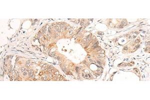 Immunohistochemistry of paraffin-embedded Human colorectal cancer tissue using HTRA1 Polyclonal Antibody at dilution of 1:55(x200) (HTRA1 anticorps)