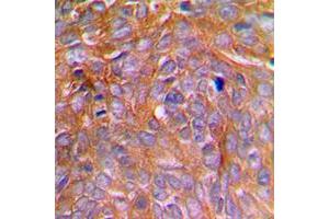 Immunohistochemical analysis of Caspase 8 (pS347) staining in human breast cancer formalin fixed paraffin embedded tissue section.