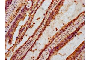 IHC image of ABIN7171705 diluted at 1:100 and staining in paraffin-embedded human colon cancer performed on a Leica BondTM system.